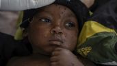 OMS dice que casos de viruela símica (mpox) en el Congo se están "estabilizando"