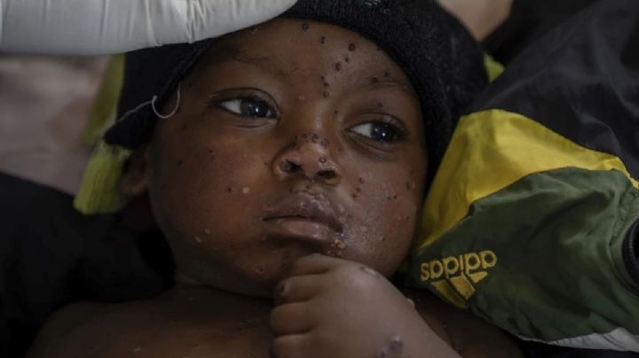 OMS dice que casos de viruela símica (mpox) en el Congo se están "estabilizando"