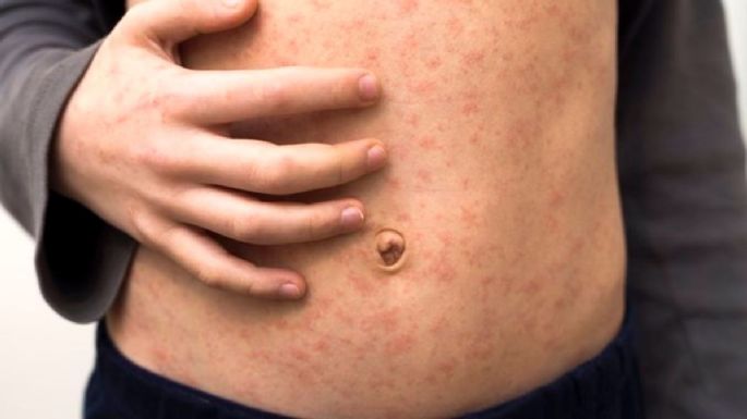 Surgen más casos de sarampión en Coahuila; Secretaría de Salud reporta ocho contagios