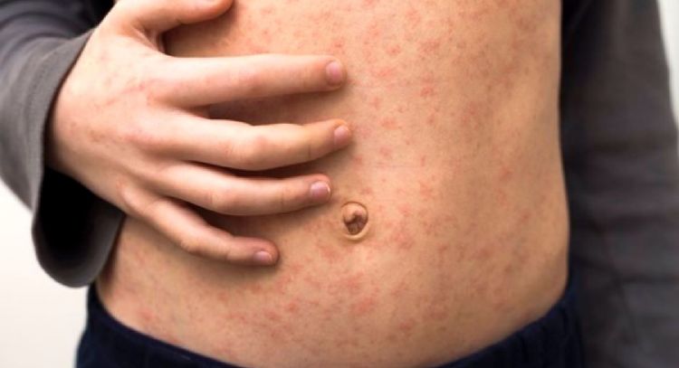 Surgen mÃ¡s casos de sarampiÃ³n en Coahuila; SecretarÃ­a de Salud reporta ocho contagios