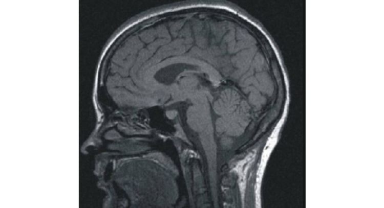 Asocian desarrollo de enfermedades cerebrales con dos químicos habituales en hogares