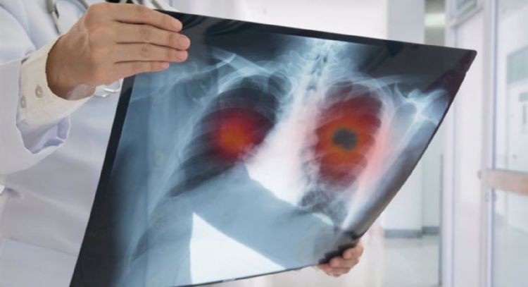 El cáncer de pulmón no microcítico aumentó 16% en los últimos 5 años, según estudio