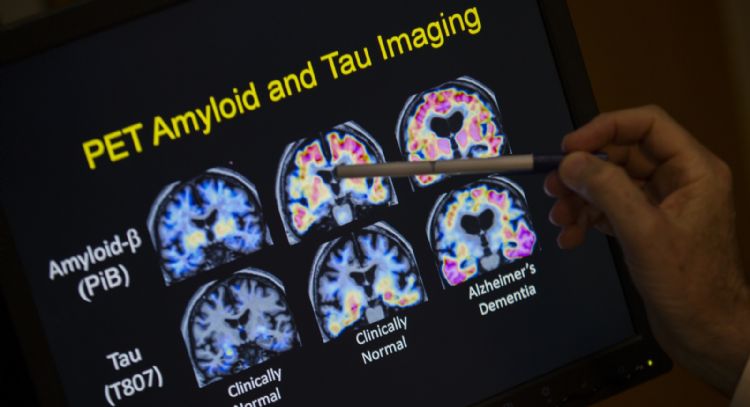 ¿Análisis de sangre para detectar el Alzheimer? Esto es lo que se sabe