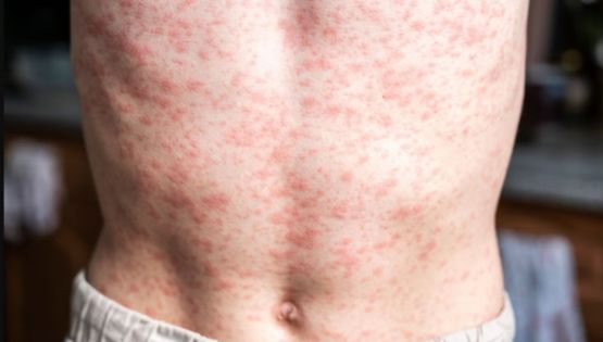 América pierde el estatus de región libre de sarampión: OPS