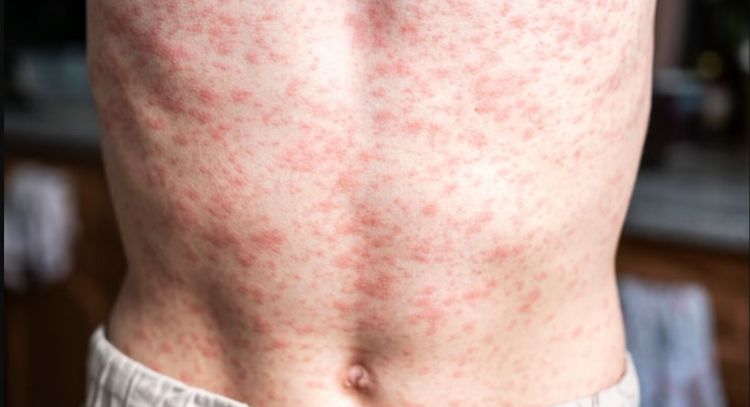 América pierde el estatus de región libre de sarampión: OPS