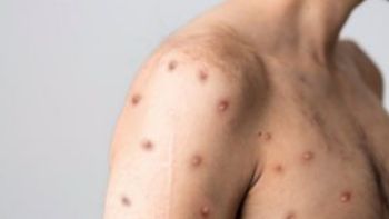 La OMS registra más de 26 mil casos de mpox en la primera mitad del año, la mayoría en África
