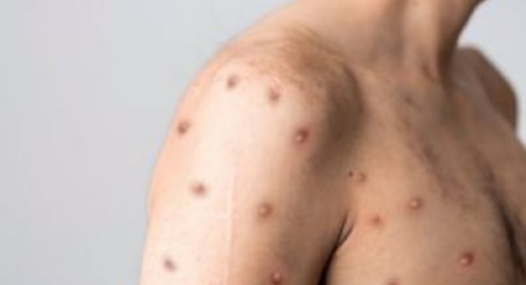 OMS pide 147 mdd para el Plan Mundial contra el mpox ante los recortes en financiación