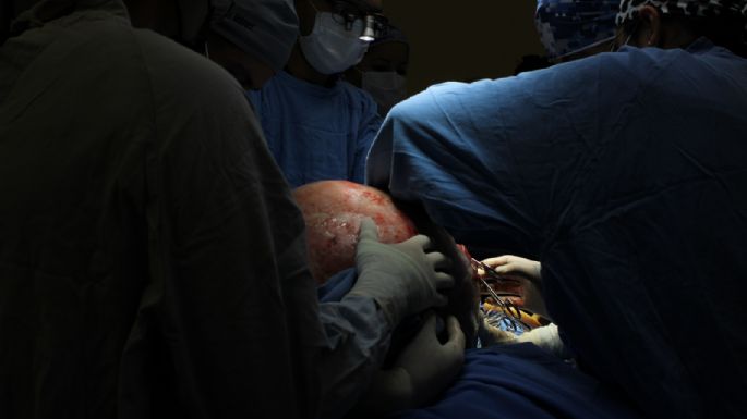 IMSS de Querétaro extirpa tumor ovárico de casi 23 kilogramos a paciente de 37 años (Video)