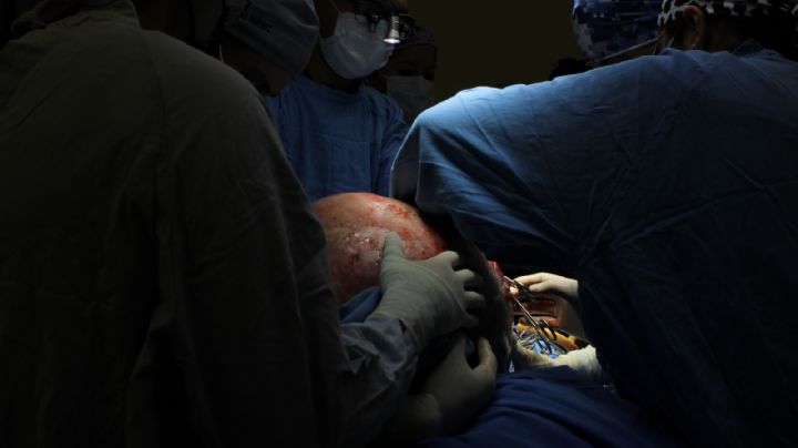 IMSS de Querétaro extirpa tumor ovárico de casi 23 kilogramos a paciente de 37 años (Video)