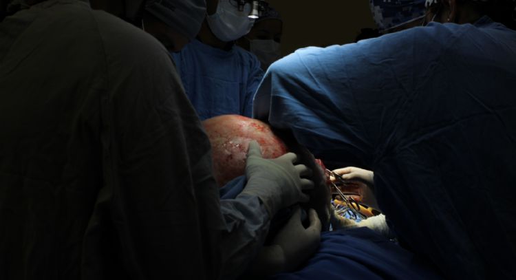 IMSS de Querétaro extirpa tumor ovárico de casi 23 kilogramos a paciente de 37 años (Video)