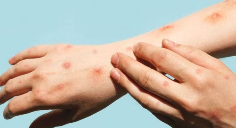 En México, Mpox registra un aumento del 860% de casos en 2025
