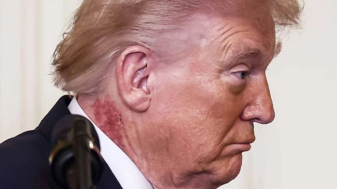 ¿Qué es esa erupción en el cuello de Trump?