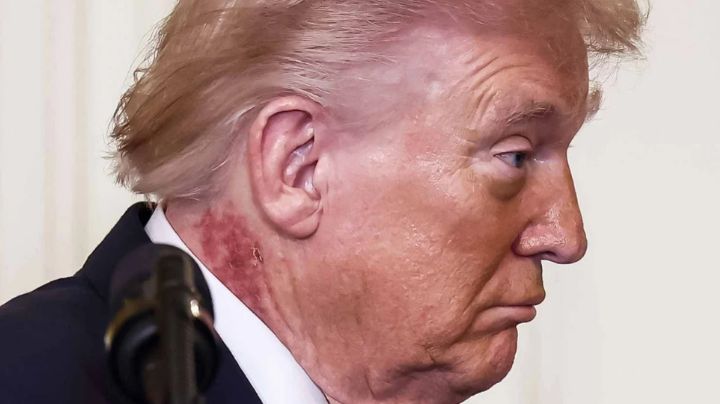 ¿Qué es esa erupción en el cuello de Trump?