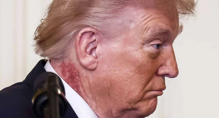 ¿Qué es esa erupción en el cuello de Trump?