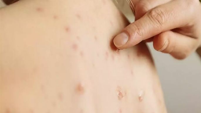 El sarampión y el dengue, las otras preocupaciones del sistema de salud