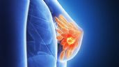Descubren un factor que explica la propagación de metástasis a los huesos en el cáncer de mama