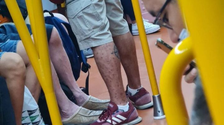 ¿Cierto o falso? Acusan a un hombre de viajar en el metro de Madrid con viruela del mono