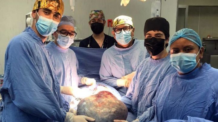 A una mujer le quitan un tumor gigante de 21 kilos en el IMSS de León