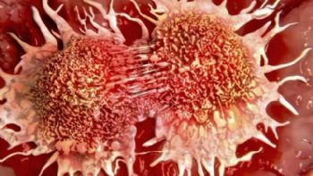Encuentran nuevos predictores de metástasis en pacientes con cáncer de páncreas en estadio inicial