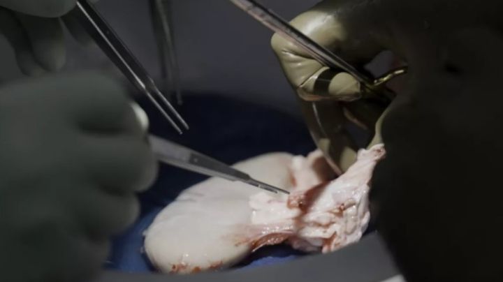 Trasplantan con éxito riñón de cerdo a hombre con muerte cerebral