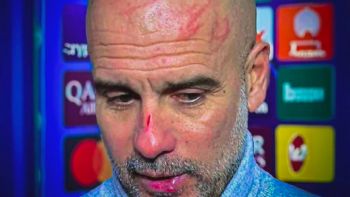 Guardiola se vuelve viral por heridas en el rostro tras empate en Champions: 'Me quería hacer daño'