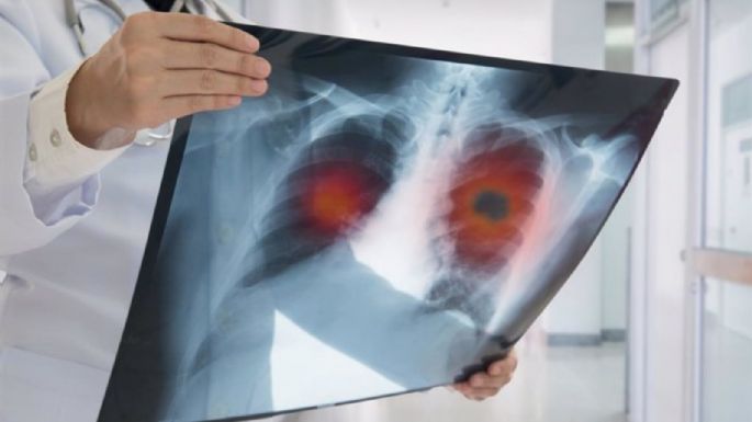 El cáncer de pulmón no microcítico aumentó 16% en los últimos 5 años, según estudio