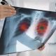 El cáncer de pulmón no microcítico aumentó 16% en los últimos 5 años, según estudio