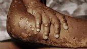 Emergencia sanitaria en África: Hay aumento y propagación rápida de "viruela del mono" (virus mpox)