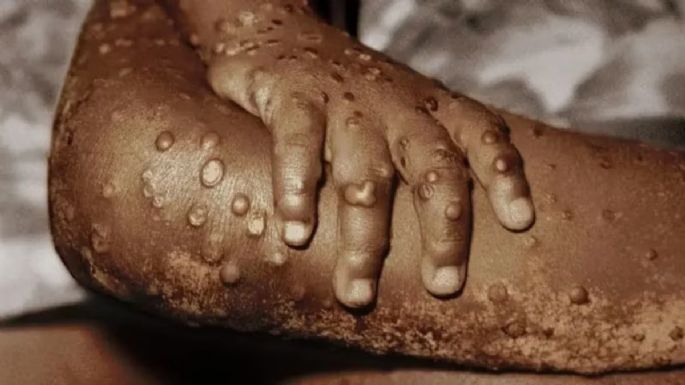 Emergencia sanitaria en África: Hay aumento y propagación rápida de "viruela del mono" (virus mpox)