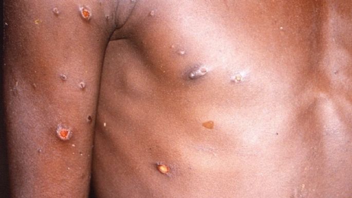 Argentina aísla un buque por caso sospechoso de virus Mpox