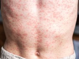 América pierde el estatus de región libre de sarampión: OPS