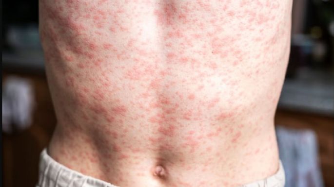 América pierde el estatus de región libre de sarampión: OPS