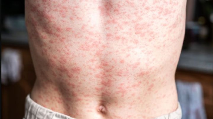 América pierde el estatus de región libre de sarampión: OPS