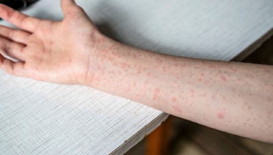 Baja California Sur alerta sobre posibles casos de sarampión e inicia cerco epidemiológico